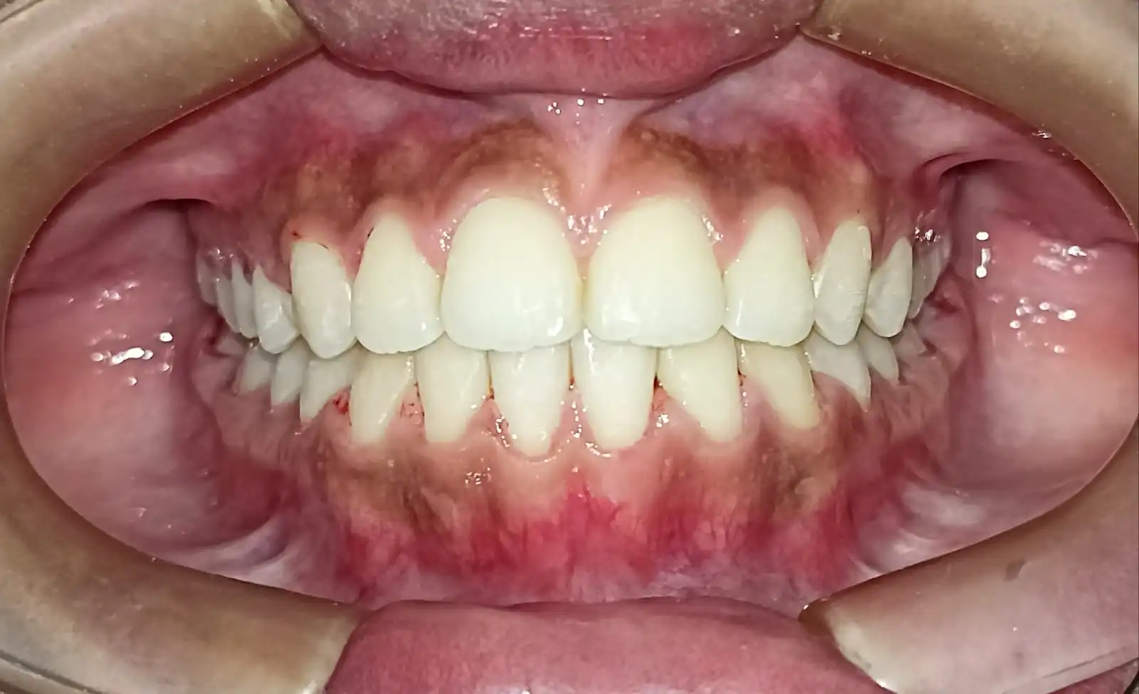 Después del tratamiento de Brianna